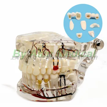 Nový príchod zubné zuby model Transparentné patologické implantát nervu model Výučby demonštrácie model