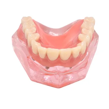 Zubné Overdenture Zuby Model Vymeniteľné Interiéru Mandibular Dolných Zubov Model Mandibular s Implantát za Zub učiteľské Študijné