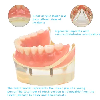 Zubné Overdenture Zuby Model Vymeniteľné Interiéru Mandibular Dolných Zubov Model Mandibular s Implantát za Zub učiteľské Študijné